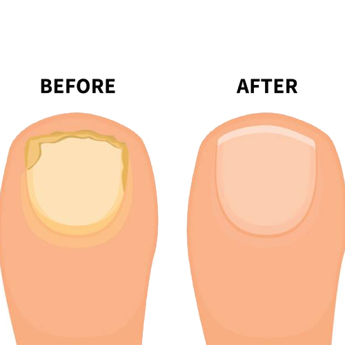 http://alldatmatterz.com/img/article/1216/nail fungus.jpg